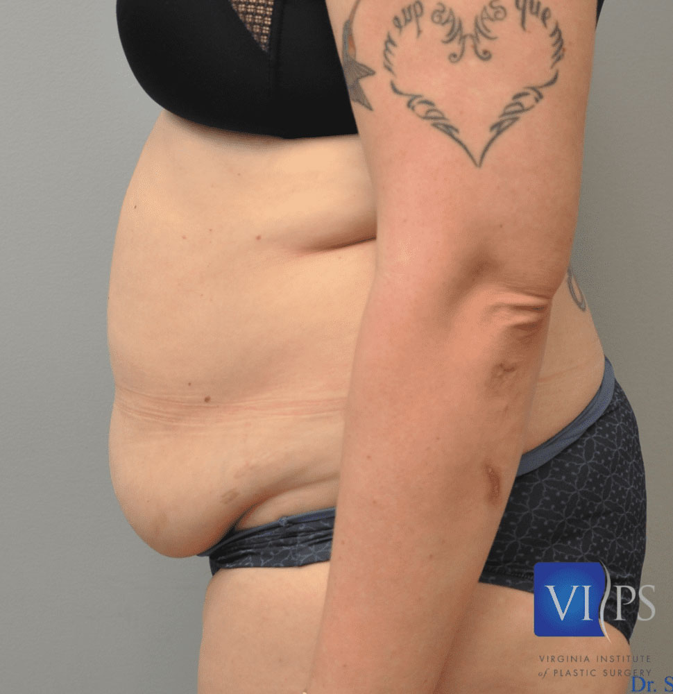 Liposuction Before and After | Little Lipo