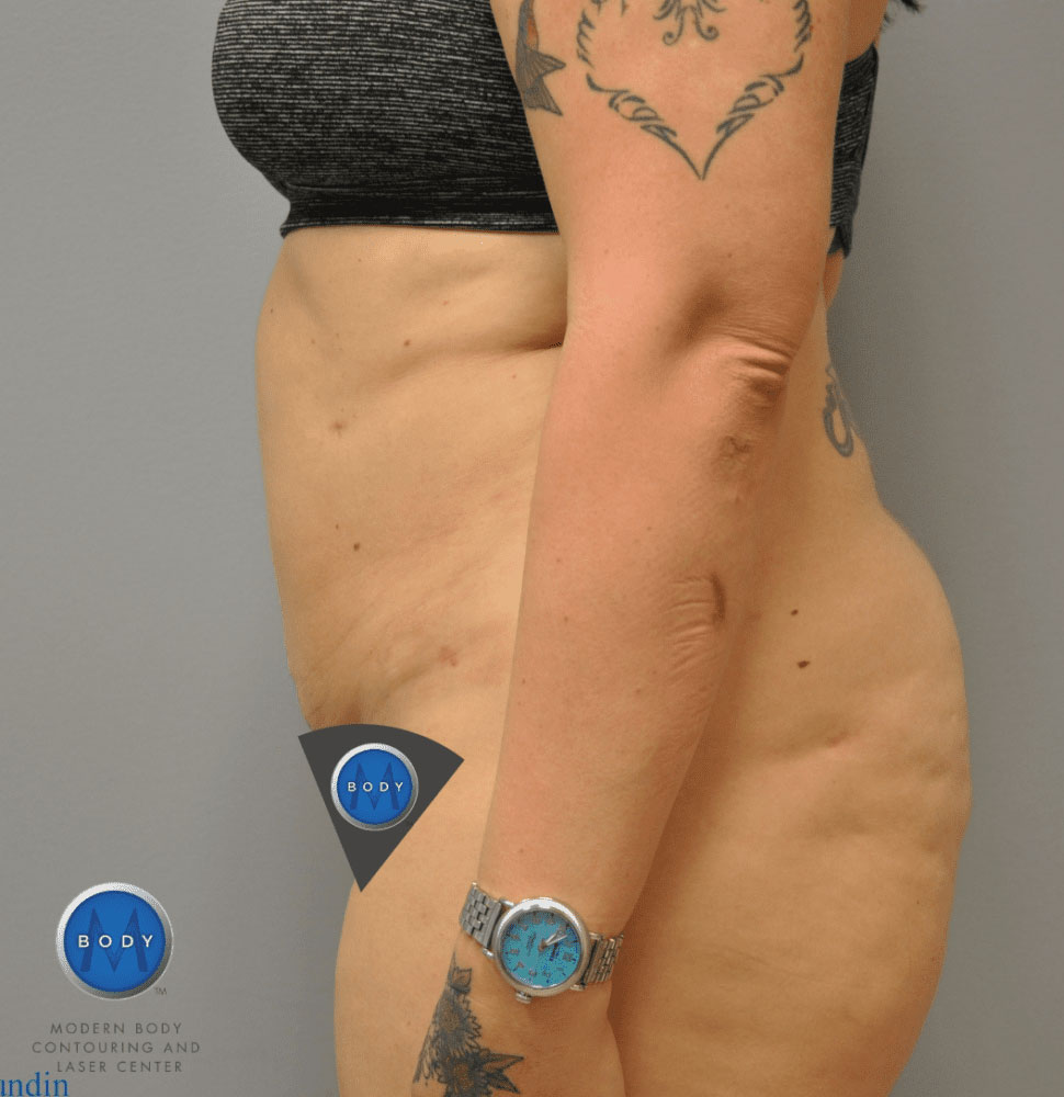 Liposuction Before and After | Little Lipo