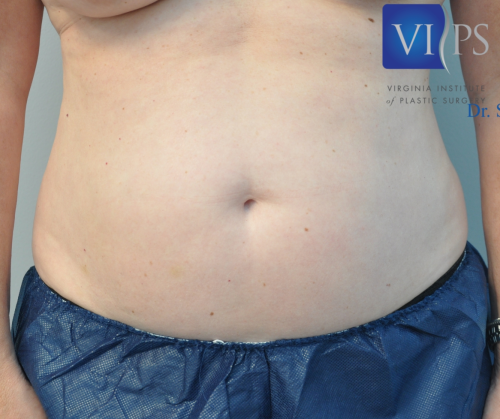 Liposuction Before and After | Little Lipo