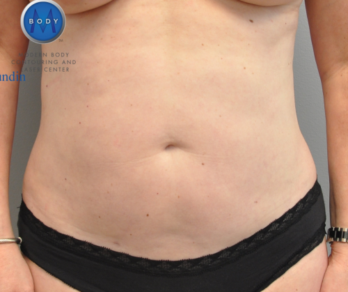 Liposuction Before and After | Little Lipo