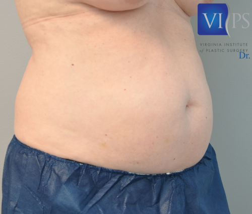 Liposuction Before and After | Little Lipo