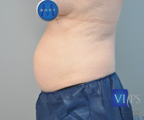 Liposuction Before and After | Little Lipo