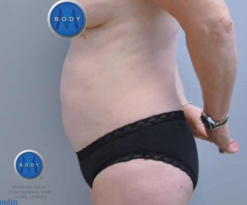 Liposuction Before and After | Little Lipo