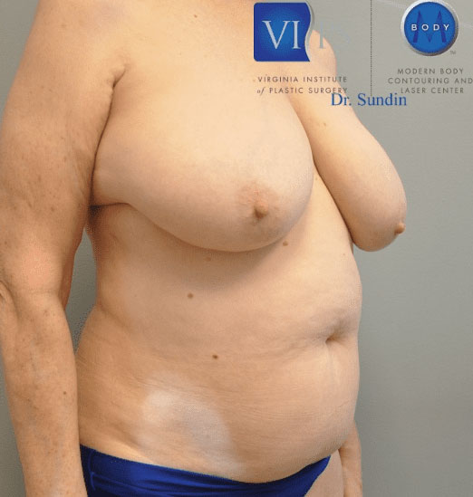 Liposuction Before and After | Little Lipo