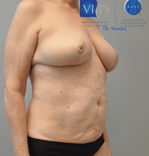 Liposuction Before and After | Little Lipo