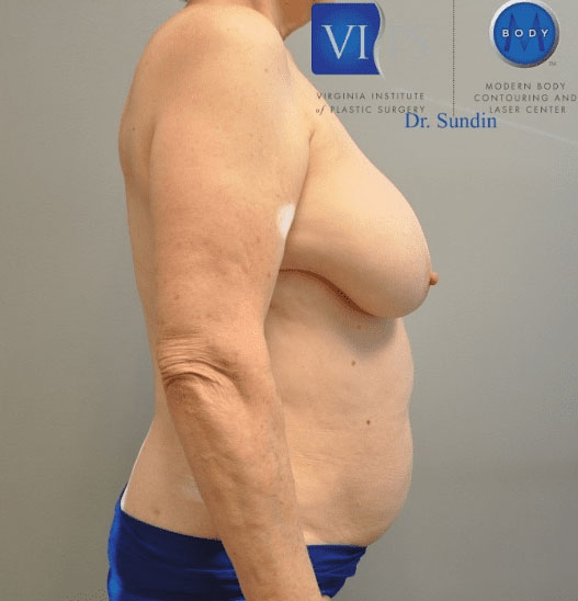 Liposuction Before and After | Little Lipo