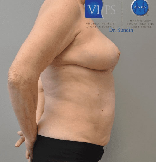 Liposuction Before and After | Little Lipo