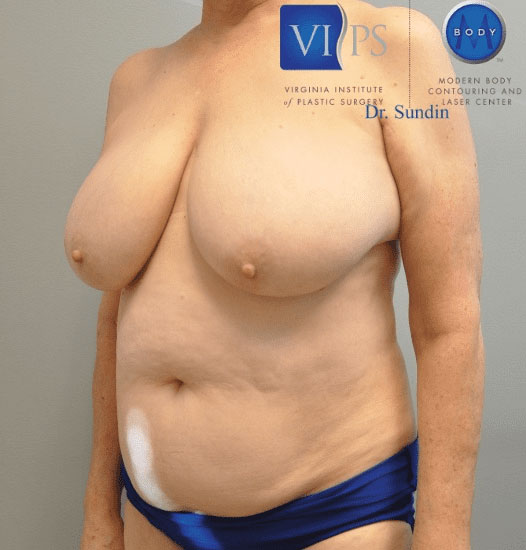 Liposuction Before and After | Little Lipo