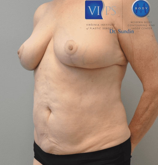 Liposuction Before and After | Little Lipo