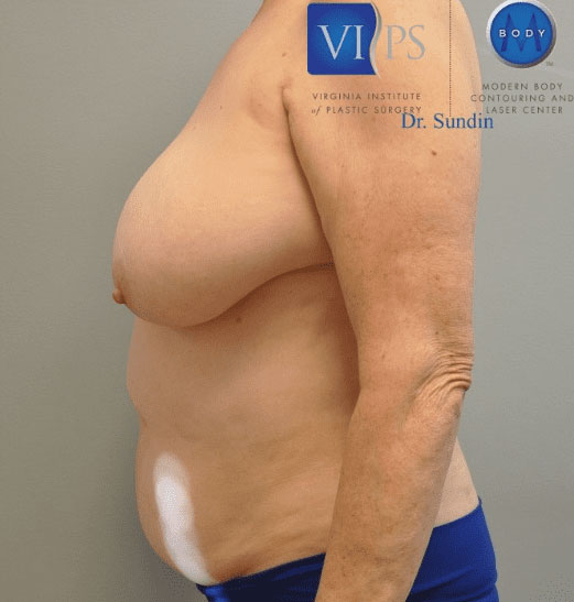 Liposuction Before and After | Little Lipo