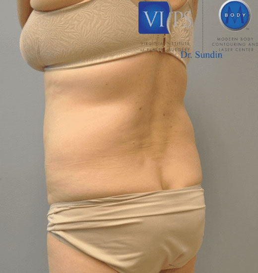 Liposuction Before and After | Little Lipo