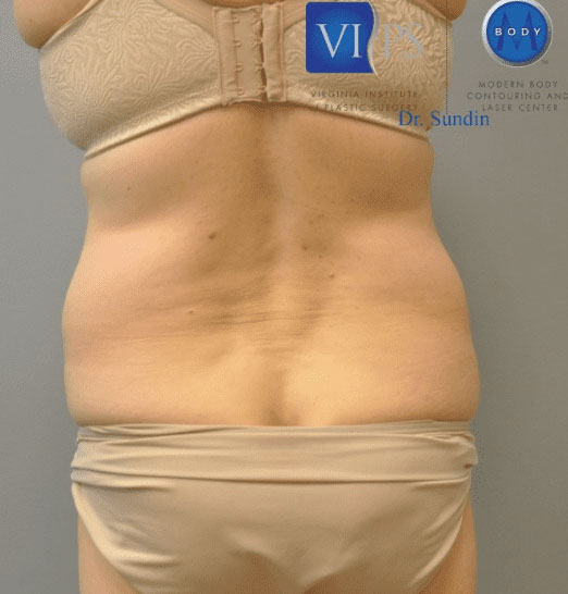 Liposuction Before and After | Little Lipo