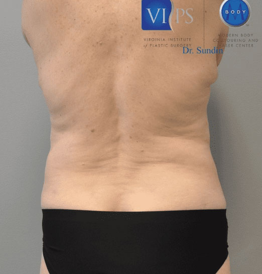 Liposuction Before and After | Little Lipo
