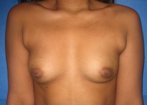 Liposuction Before and After | Little Lipo