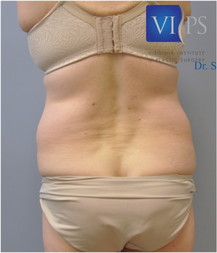 Liposuction Before and After | Little Lipo