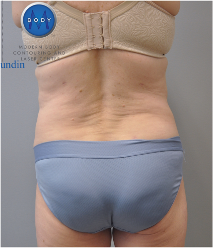 Liposuction Before and After | Little Lipo