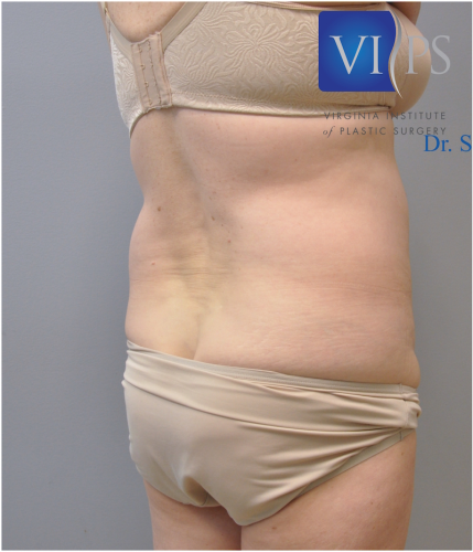 Liposuction Before and After | Little Lipo
