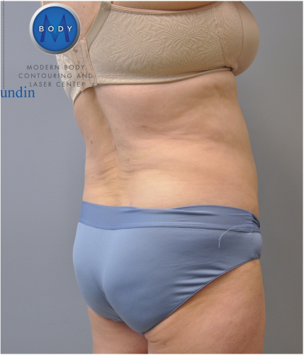 Liposuction Before and After | Little Lipo