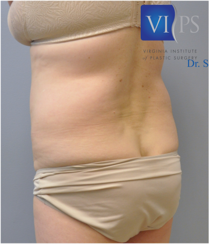Liposuction Before and After | Little Lipo