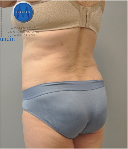Liposuction Before and After | Little Lipo