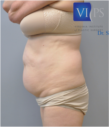 Liposuction Before and After | Little Lipo