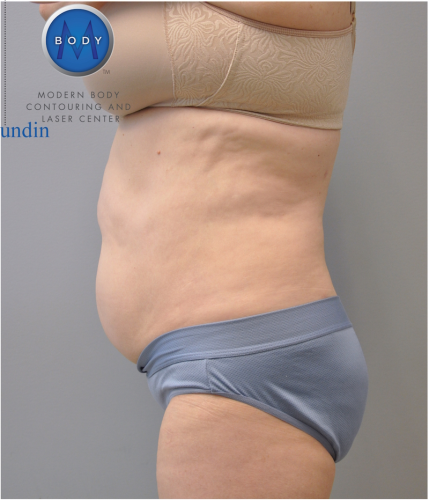 Liposuction Before and After | Little Lipo