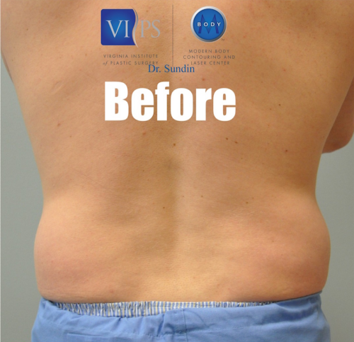 SmartLipo