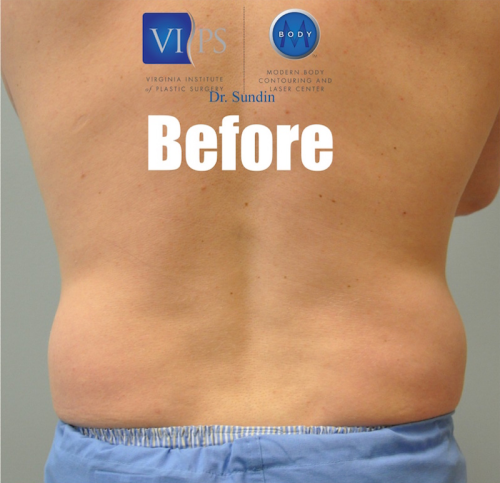 Liposuction Before and After | Little Lipo