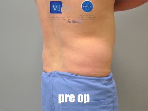 Liposuction Before and After | Little Lipo