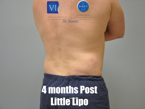 Liposuction Before and After | Little Lipo