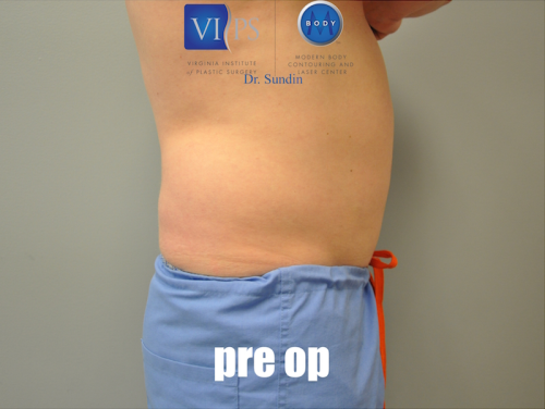 Liposuction Before and After | Little Lipo