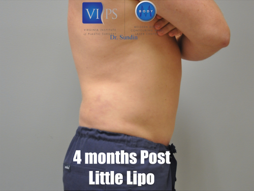 Liposuction Before and After | Little Lipo