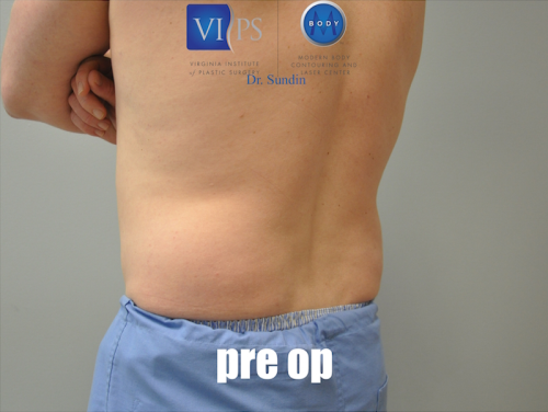 Liposuction Before and After | Little Lipo