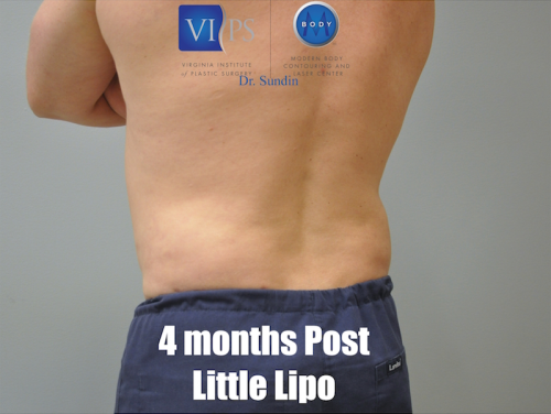 Liposuction Before and After | Little Lipo