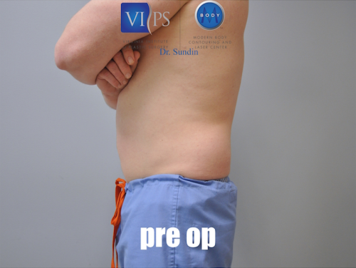 Liposuction Before and After | Little Lipo