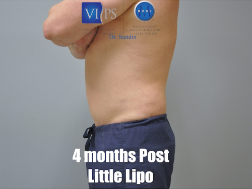 Liposuction Before and After | Little Lipo