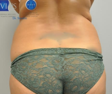 Liposuction Before and After | Little Lipo
