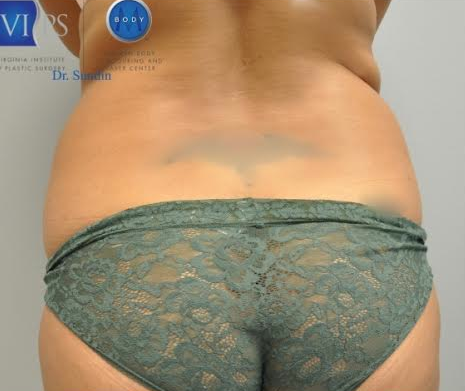 Hip Liposuction Richmond