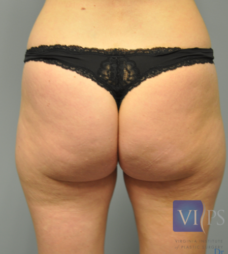 Back Liposuction