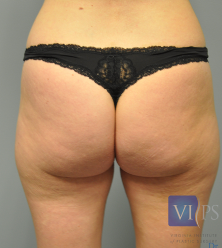 Liposuction Before and After | Little Lipo