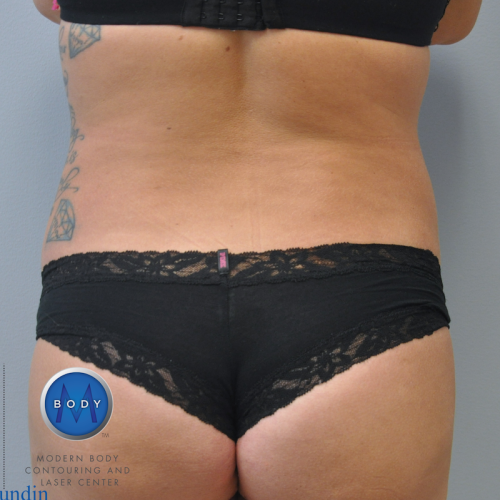 Back Liposuction Richmond
