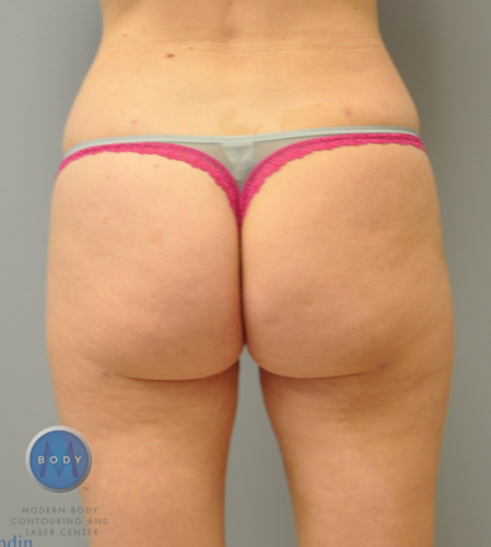 Back Liposuction
