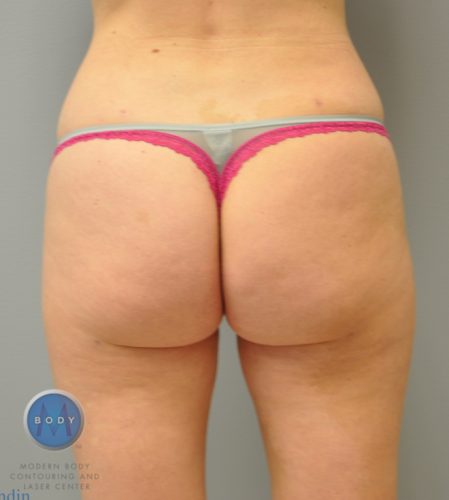 Liposuction Before and After | Little Lipo