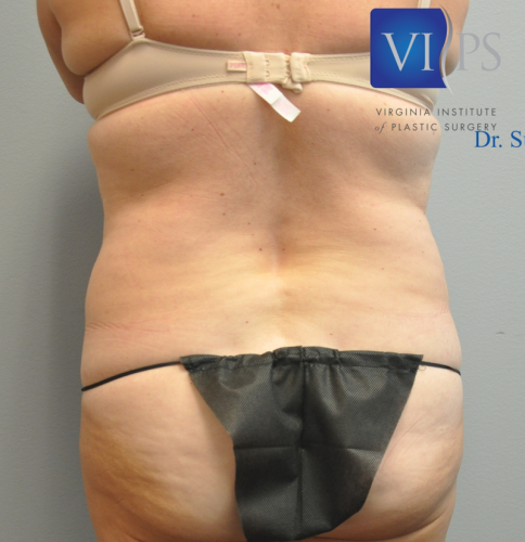 Liposuction Before and After | Little Lipo