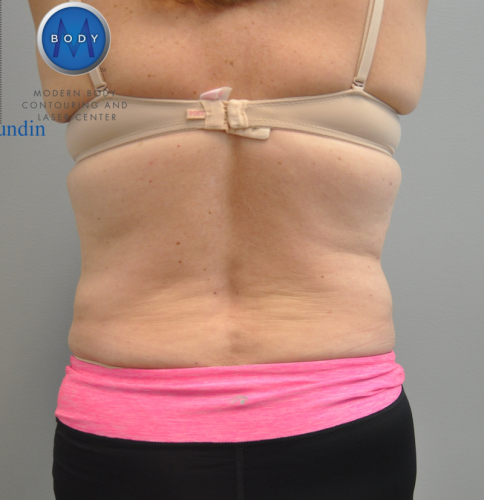 Thigh Liposuction Richmond