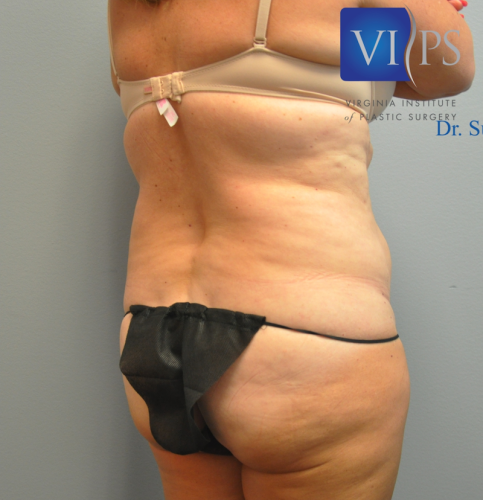 Liposuction Before and After | Little Lipo