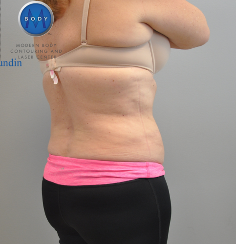 Liposuction Before and After | Little Lipo