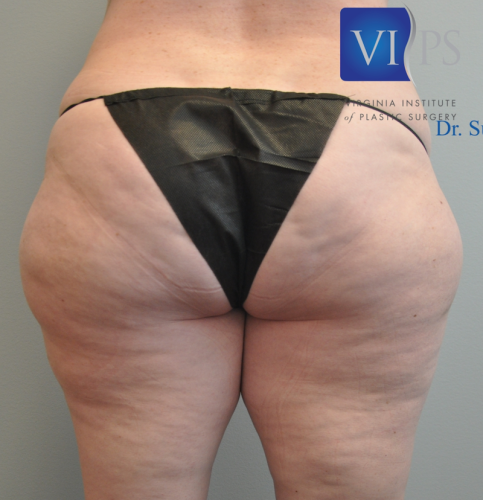 Back Liposuction