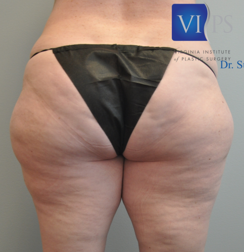 Back Liposuction Richmond