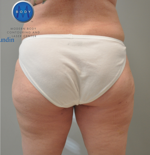 Back Liposuction Richmond